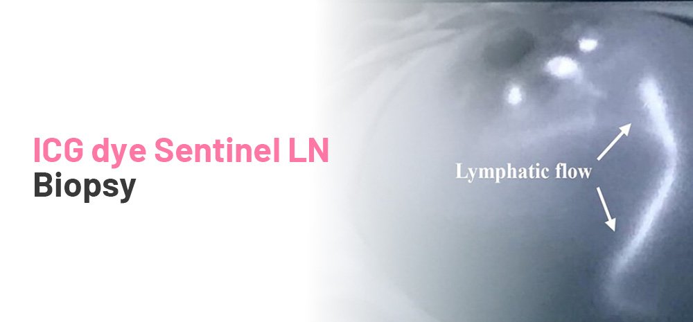 ICG dye Sentinel LN Biopsy